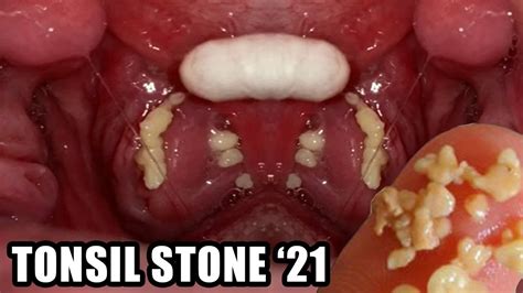 2021s Biggest Tonsil Stones Tonsil Stone Removal Tools Youtube