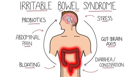 Irritable Bowel Syndrome IBS Including Symptoms Criteria Treatment YouTube
