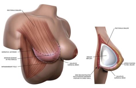 Internal Bra Breast Lift In Houston Basu Aesthetics