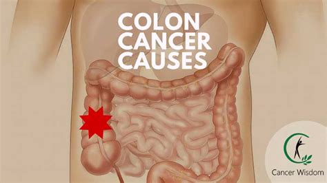 Find out if you qualify. Colon Cancer Causes Explained - Find Out The Reason You ...