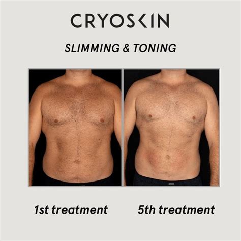 Cryoskin Before And After Photos Body Contouring Academy