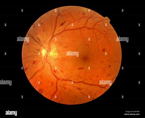 Fundus Camera Image Ophthalmoscope Of The Retina Showing Acute Non