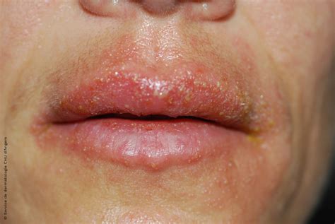 Mild Eczema Around Mouth
