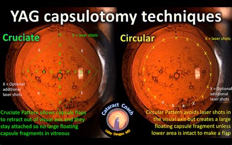 Yag Laser Capsulotomy Techniques Cataract Coach