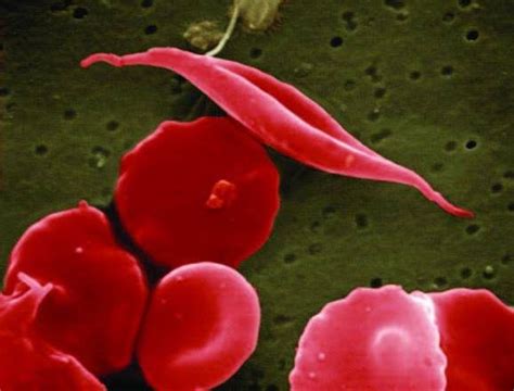 Recuperación De La Expresión De La Hemoglobina Fetal Para Tratar La Anemia Falciforme Femexer