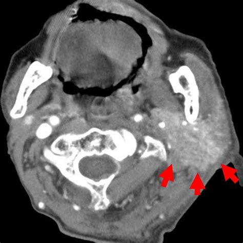 Contrast Enhanced Computed Tomography Ct Of The Neck Showing