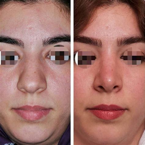 Bulbous Nose Rhinoplasty Before And After Images Rhinoplasty Before