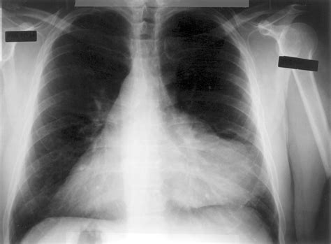 An Abnormal Chest X Ray Radiology Jama Surgery Jama Network