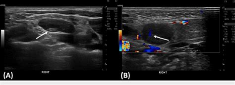 A Ultrasonographic Imaging Of The Right Cervical Lymph Node With