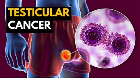 Testicular Cancer Causes Signs And Symptoms Diagnosis And Treatment Youtube