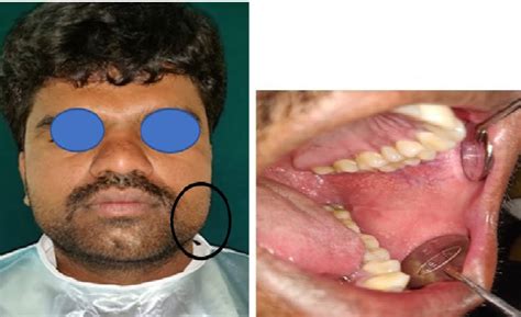 Clinical Extra Oral And Intra Oral Photography Of Swelling In The Left