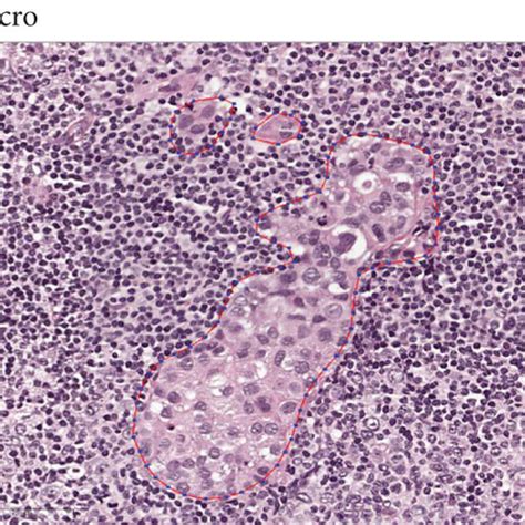 Images Of Three Categories Of Lymph Node Metastasis A Normal B