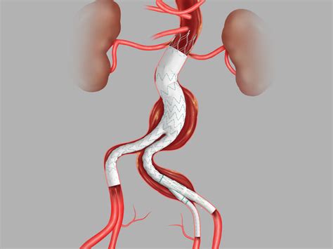 Zenith Alpha™ Abdominal Endovascular Graft Bifurcated Main Body Graft