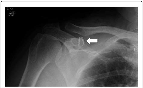 Primary Repair Of Ac Ligaments And Coracoclavicular Ligaments With