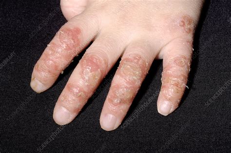 Infected Eczema Stock Image M1500314 Science Photo Library