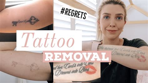 Some people compare the sensation of laser removal to. LASER TATTOO REMOVAL/ Before & After/ Best Laser/ COST ...