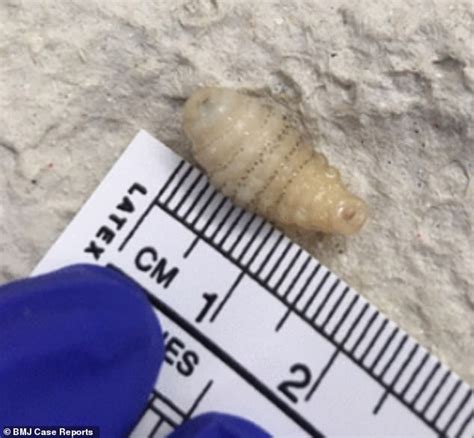 Doctors Remove Two Maggots From A British Womans Scalp Daily Mail Online