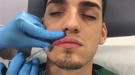 Restylane Defyne Lip Filler Treatment In A Male Patient By Dr Shaun