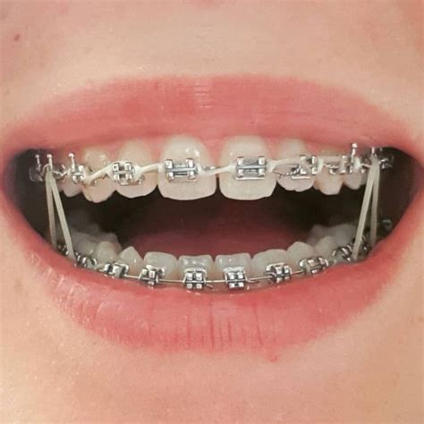 Pin By Shrood Burgos On Braces In 2021 Cute Braces Braces Colors Perfect Teeth
