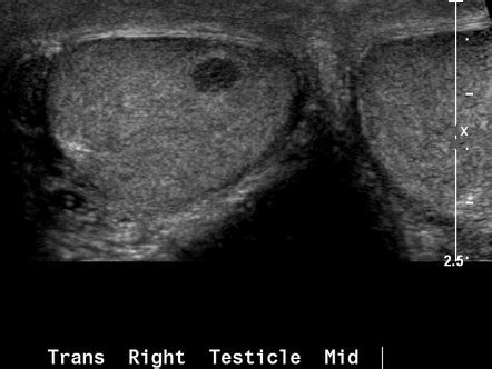 Leydig Cell Tumour Of The Testis Radiology Reference Article