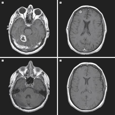 Successful Treatment Of Histoplasmosis Brain Abscess With Voriconazole
