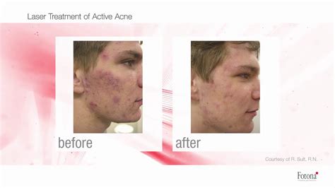 Fotona Acne And Acne Scar Treatment Sydney Cbd And Wahroonga Youtube