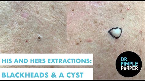 His And Hers Extractions Blackheads And A Cyst Youtube