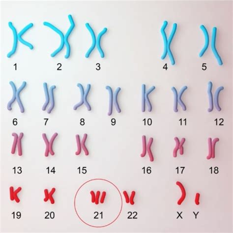 Down syndrome karyotype (formerly called trisomy 21 syndrome or mongolism), human male, 47,xy,+21. Meiosis Mistakes | Let's Talk Science