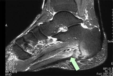 They are generally divided into two sets: How to diagnose plantar fasciitis | plantar fasciitis ...