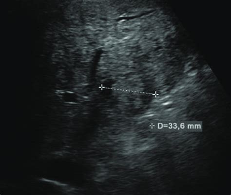 Mode Sonography Of The Liver Displaying A Granuloma Of 33 Mm