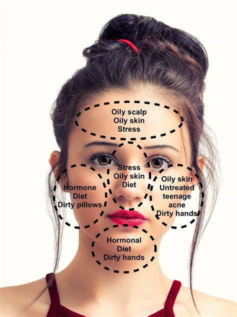 Acne Treatment Acne Face Map And Solutions