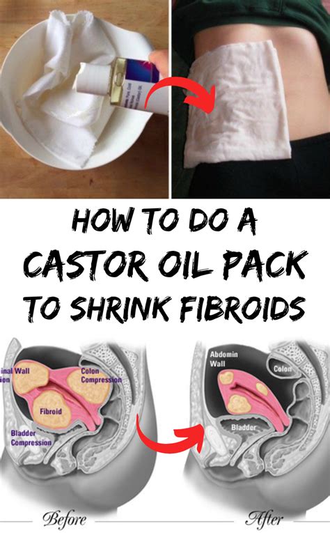 How To Do A Castor Oil Pack To Shrink Fibroids Health And Remedies