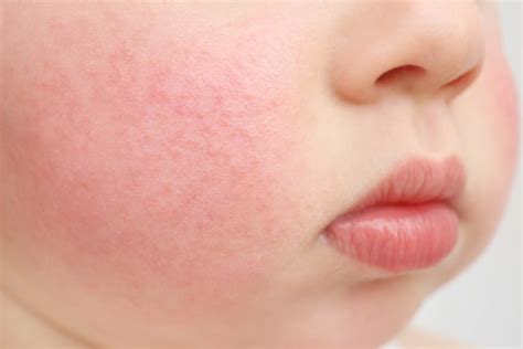 Fifth Disease In Babies And Kids Happiest Baby