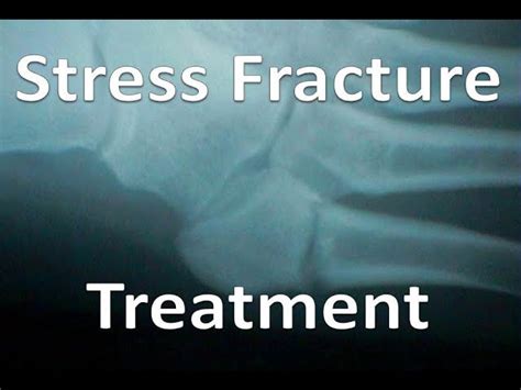Stress Fracture Of The Calcaneus The Complete Treatment Guide