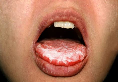 Fungal Infections And The Oral Cavity Revise Dental