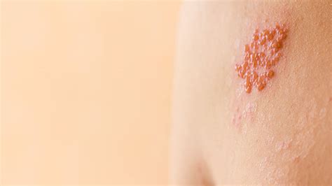 how to recognize and treat a shingles rash river s edge hospital and clinic river s edge