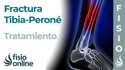 Tratamiento De La Fractura De Tibia Y Peroné Desde La Fase De