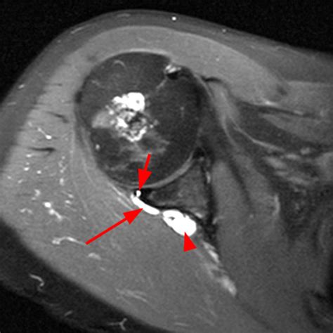 Shoulder Cysts Radsource