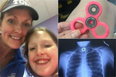 Us Mother Warns About Choking Hazard After Daughter Swallows Fidget Spinner Part The Straits Times
