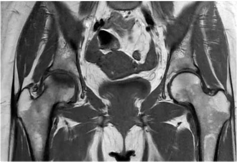 Mri T 1 Weighted Image Shows Osteonecrosis Of The Femoral Head With A