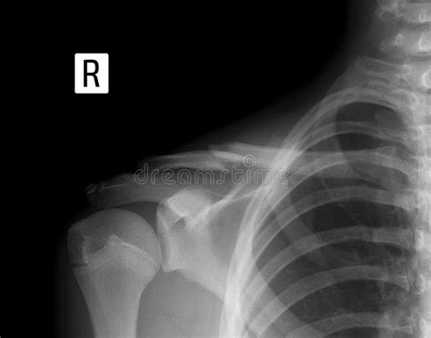 X Ray Of The Right Collarbone Fracture Of Clavicle Stock Photo