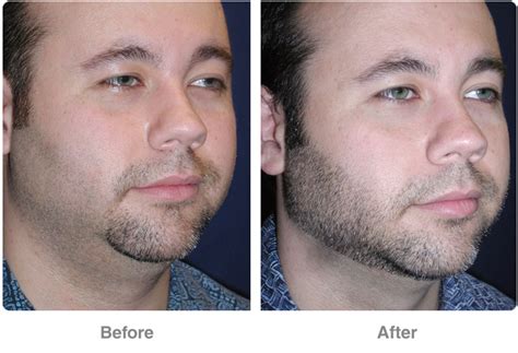 Liposuction is a cosmetic procedure that removes fat that you can't seem to get. Liposuction in Las Vegas NV - Dr. Troell Top Lipo Surgeon