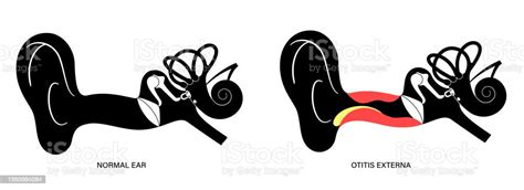 Swimmers Ear Otitis Stock Illustration Download Image Now Acute