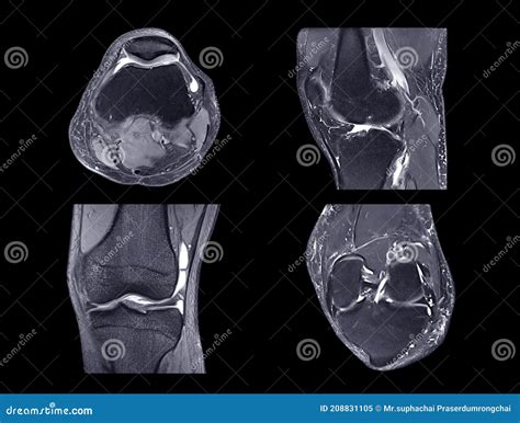 Magnetic Resonance Imaging Or Mri Knee Comparison Sagittal Pdw And Tiw