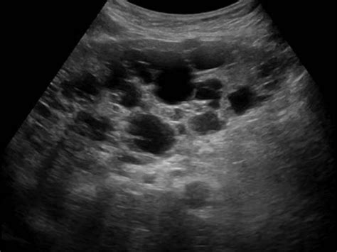 Abdomen And Retroperitoneum 11 Liver Case 114 Liver Cysts