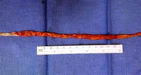 Covenant Physician Removes 9 Inch Blood Clot From Patients Heart With