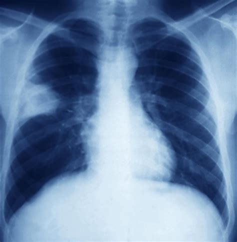 Lung Abscess X Ray Photograph By Zephyr Pixels