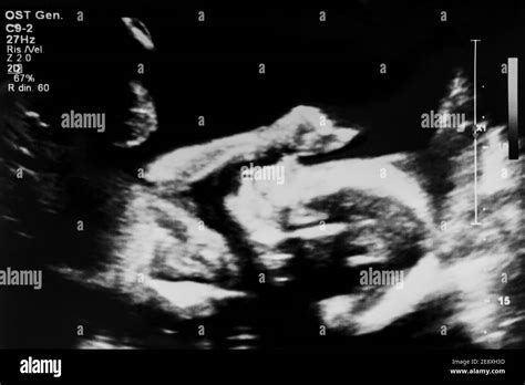 Fetus 20 Weeks Black And White Stock Photos And Images Alamy