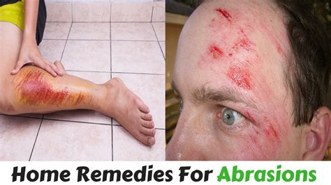 Abrasion Treatment With Natural Home Remedy Skin
