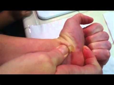 They are sometimes asymptomatic, but can also cause a burning sensation, skin irritation, and can make walking and wearing shoes difficult. Popping a ganglion cyst - YouTube